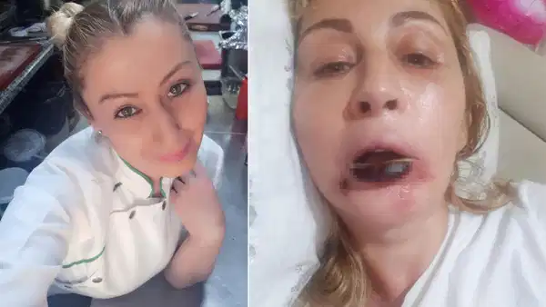 Estetik mağduru Songül Uzunoğlu dolgu sonrası dudak doku kaybı